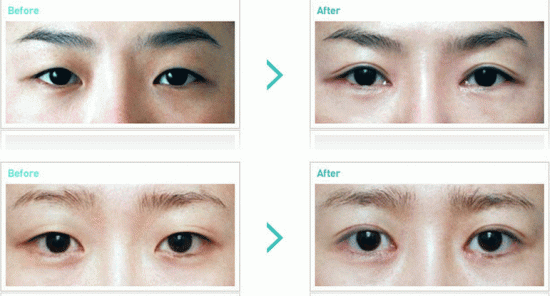 Sử dụng công nghệ Plasma của shapeline điều trị hiệu quả mắt bị sụp mí