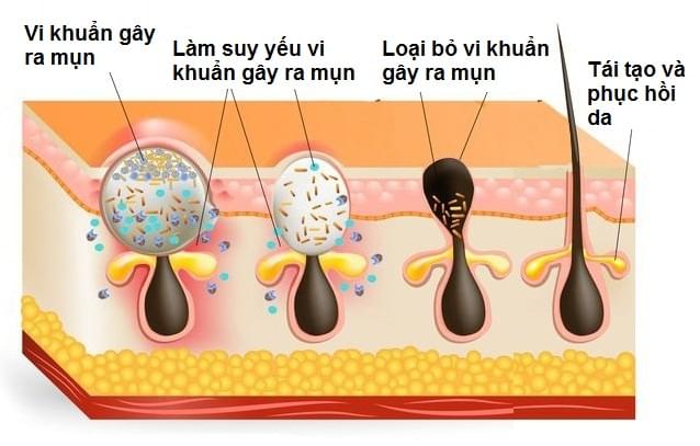 Điều trị da mụn hiệu quả