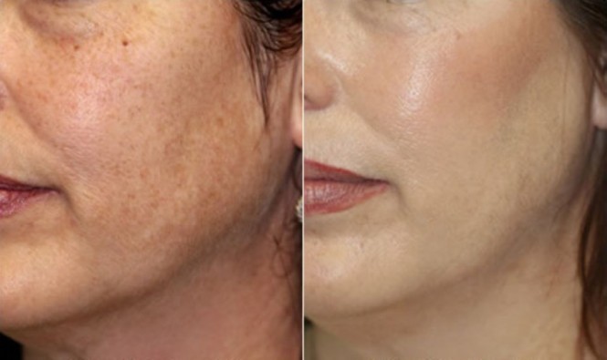 Kết quả sau khi sử dụng làm đẹp da bằng công nghệ cao Shapeline