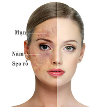 Điều trị da mụn hiệu quả