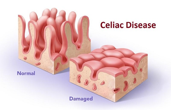 Bệnh Celiac ảnh hưởng như thế nào tới làn da?