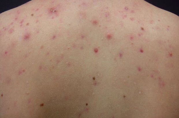 Bệnh gan ảnh hưởng đến làn da