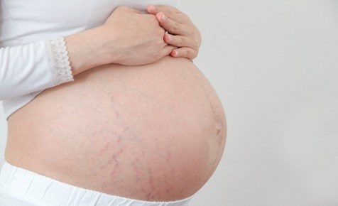 Mang thai là nguyên nhân phổ biến nhất hình thành nên những vết rạn