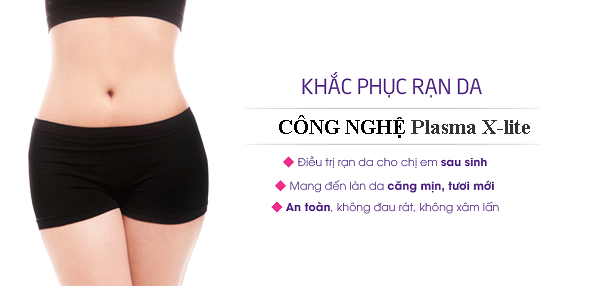 Công nghệ Plasma X-lite chữa rạn da