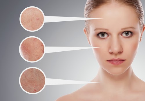 Trị mụn bằng đá lạnh 2