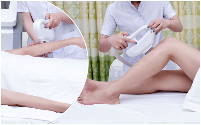 Quy trình thực hiện quá trình triệt lông