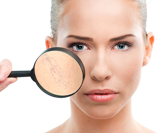 Biểu hiện của giãn mao mạch dưới da