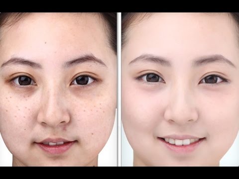điều trị nám