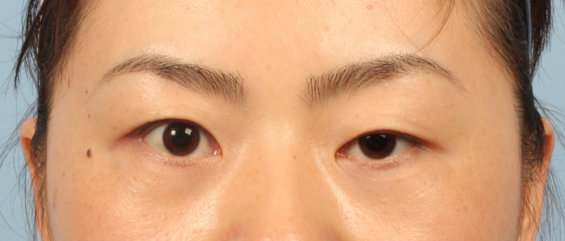 Người bị sụp mí mắt