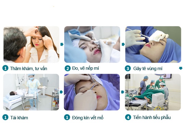 Qúa trình thẩm mỹ mắt hai mí