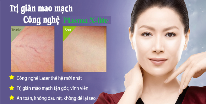 Điều trị giãn mao mạch hiệu quả với công nghệ Cellulite Massage và Công nghệ Plasma X-lite