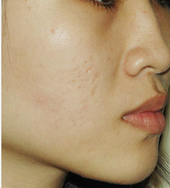 Da mặt bị sẹo lõm